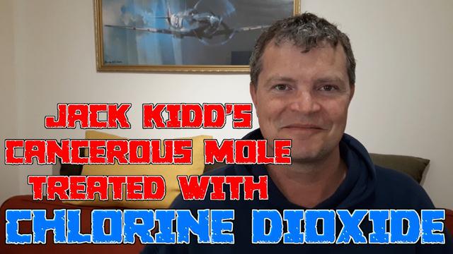 JACK KIDDS CANCEROUS MOLE TREATED WITH CHLORINE DIOXIDE (MMS) INCREDIBLE 24-4-2022